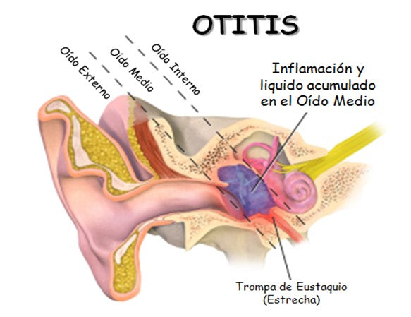 Otitis: síntomas y tratamiento
